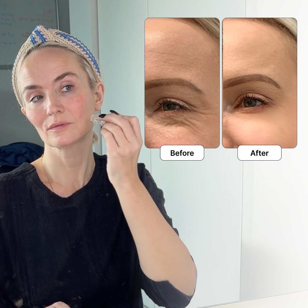 Woman using Glamory micro-infusion device with before and after results