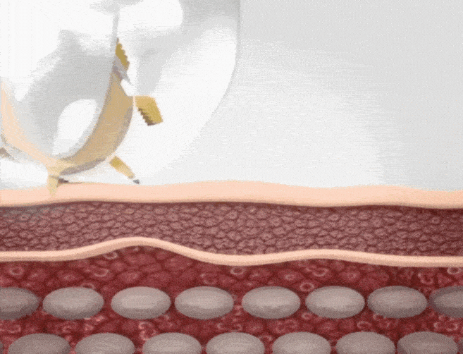 Animation showing micro-infusion serum delivery into skin layers